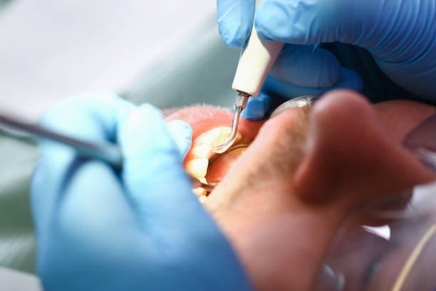 Best Emergency Dental Extractions in Lannon, WI